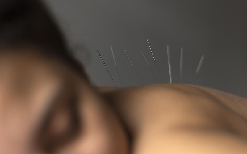 Acupuncture treatment in liverpool.jpg